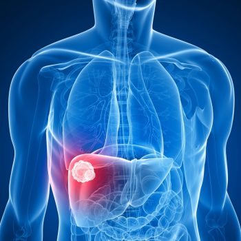 bigstock-liver-cancer-75701764